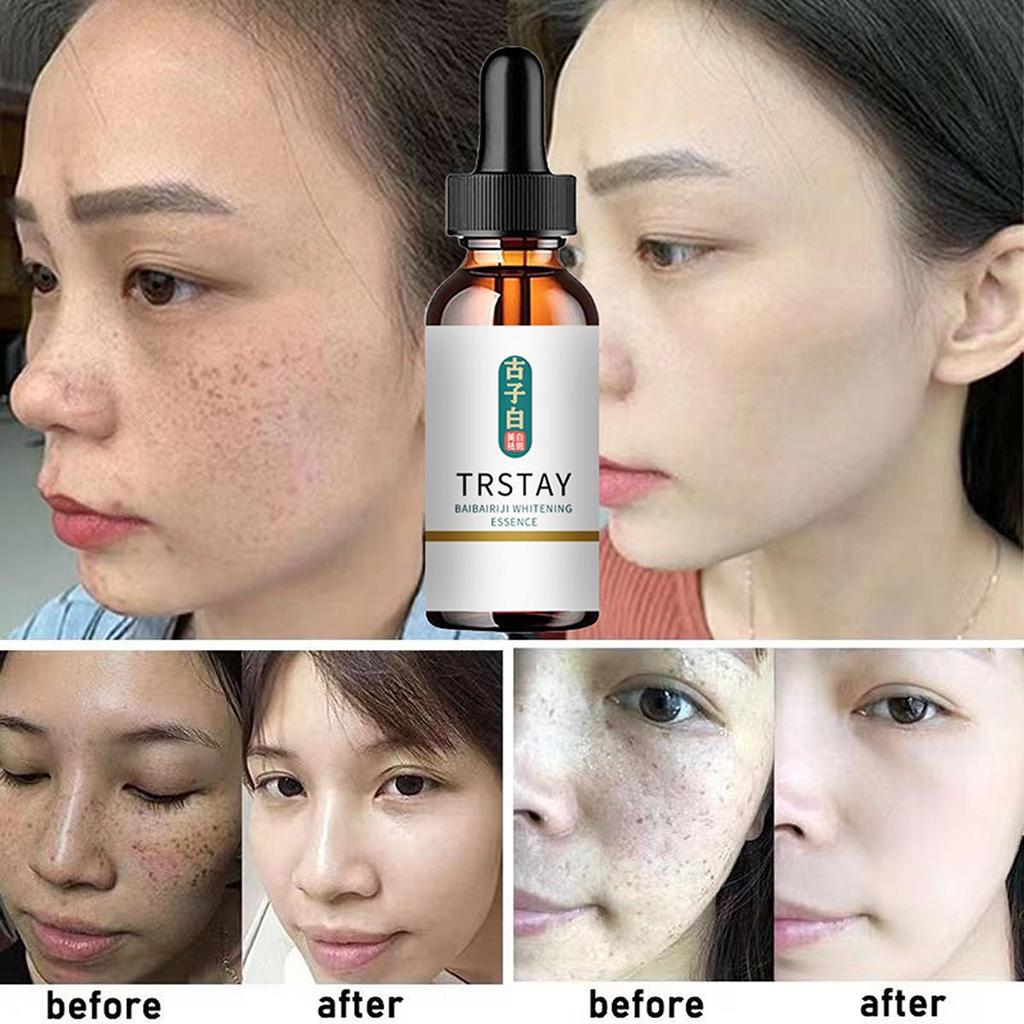Whitening Freckle Cream Effective Remove Melasma Dark Spots Cream Fade  Moisturize Brighten Smooth Beauty Face Skin Care