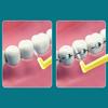 20Pcs L Type Angled Interdental Brush For Braces Micro Soft Brush For Dental Brackets Cleaning Short Handle Brushes