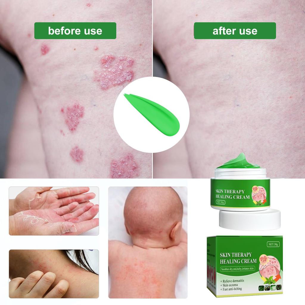Moisturizing Skin Anainst Itch Cream,Remove Itching, Sweat Blisters, Skin Swelling,