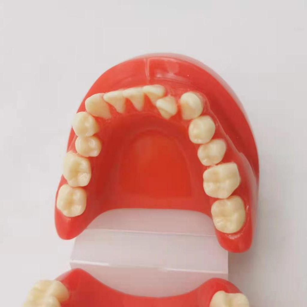 Children's Dental Malocclusion Teaching Model - Red Protrusion