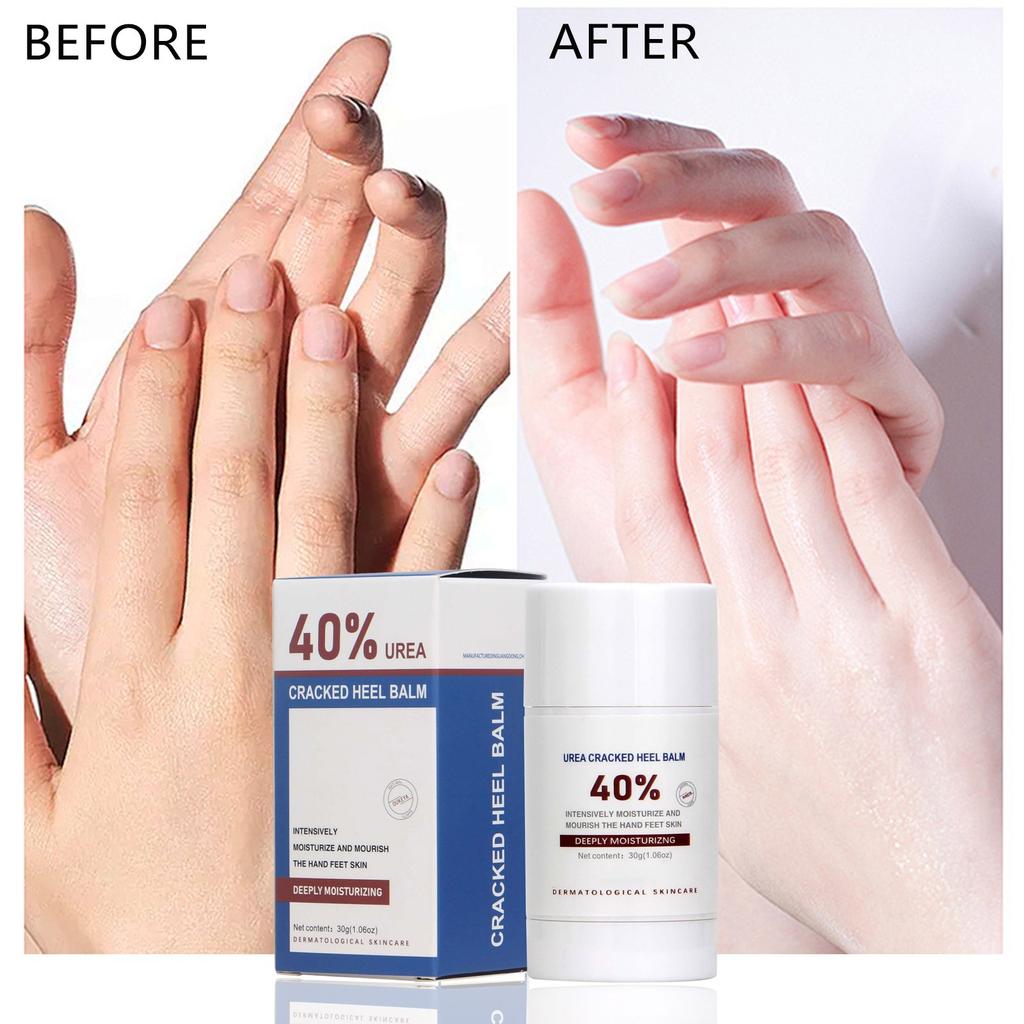 Бальзам-карандаш с мочевиной 40 процентов, бальзам для пяток, бальзам-карандаш для рук с мочевиной и бальзам-карандаш для ног для увлажнения и сухой потрескавшейся кожи, потрескавшейся пятки, предотвращения обморожения(30г)