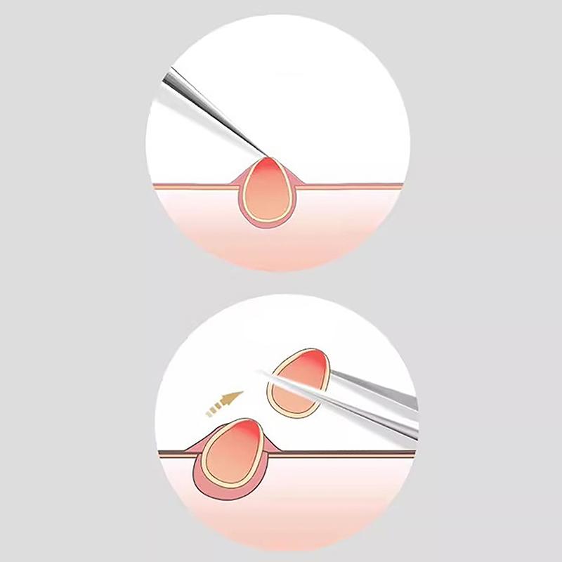Инструмент для удаления черных точек с черными точками, прыщи, иглы для выдавливания прыщей, инструменты, ложка для чистки лица, экстрактор комедонов, очиститель пор