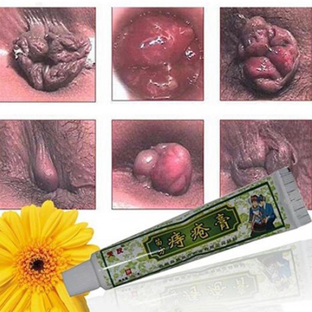 KpacoTa Крем для наружного лечения мази от геморроя в 3 тюбиках