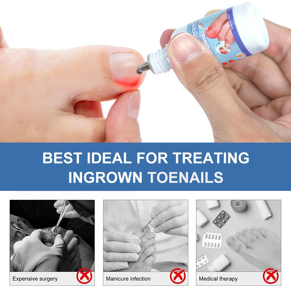 Toenail Fungus Care Solution, FastActing Nail Care Solution for Fungus Under & Around Restores The Healthy Appearance of Nails