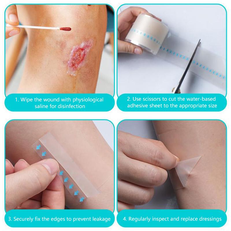 1 рулон гидроколлоидных пластырей для эффективного ухода за ранами, экстратонкая, мягкая, водонепроницаемая самоклеящаяся лента для покрытия шрамов