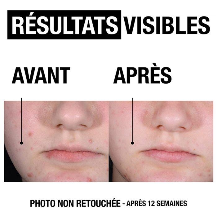 Neutrogena Anti-Boutons + Gel Nettoyant Visage Peaux à Tendance Acnéique 200ml
