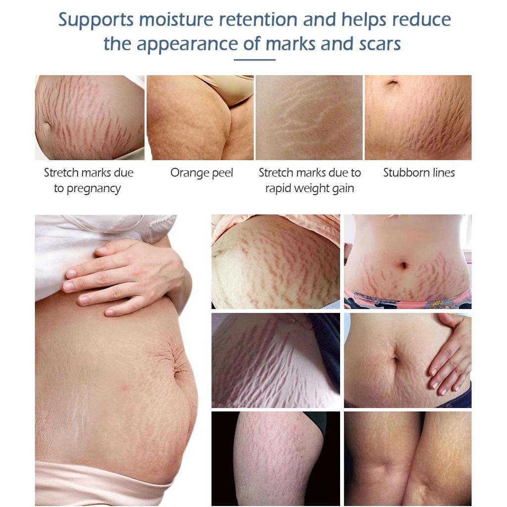 VIBRANT GLAMOUR Крем для удаления растяжек, набор кремов для ремонта тела, шрамы для беременных, линии ожирения, шрамы, антивозрастной укрепляющий уход за кожей, 2 шт.