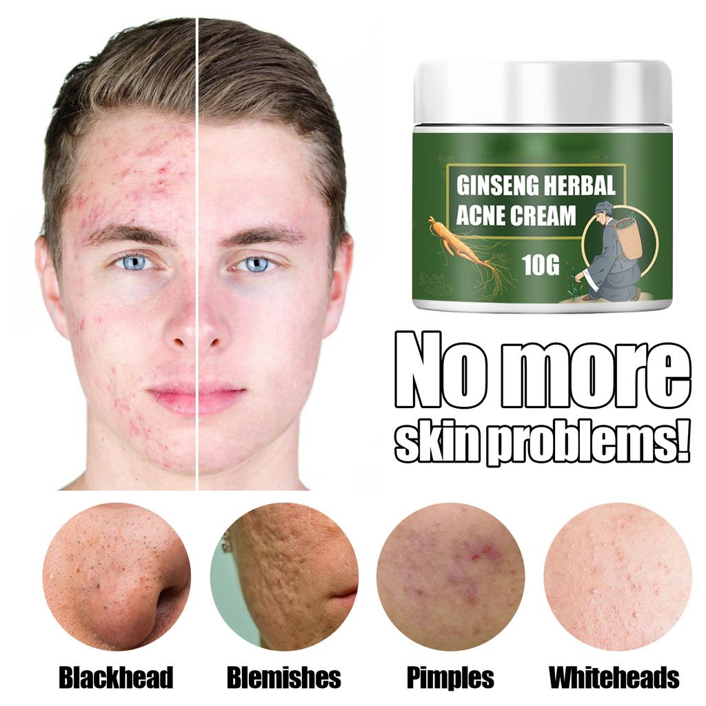 Эффективный крем для удаления прыщей, лечение шрамов от прыщей, сужение пор, контроль масла, отбеливание, увлажнение лица