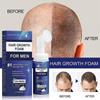 3pcs Regaine For Men Hair Loss Regrowth Scalp Foam - Extra Strength-yvan