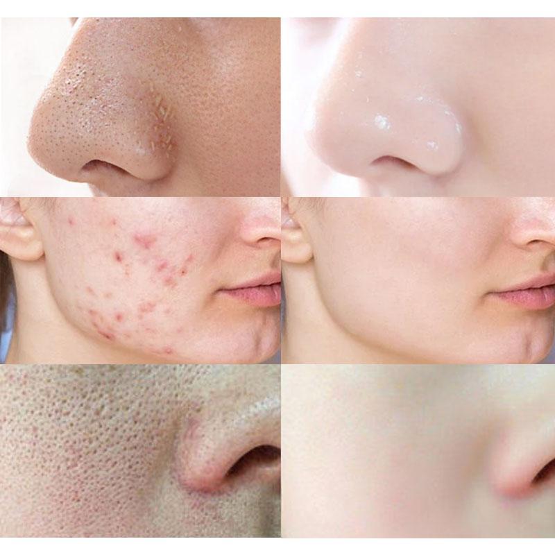 Очищающая пузырьковая маска для лица, сужающая поры, удаляющая черные точки, глубоко очищающая, контролирующая жирность кожи, против акне, осветляющая, отбеливающая, уход за кожей лица