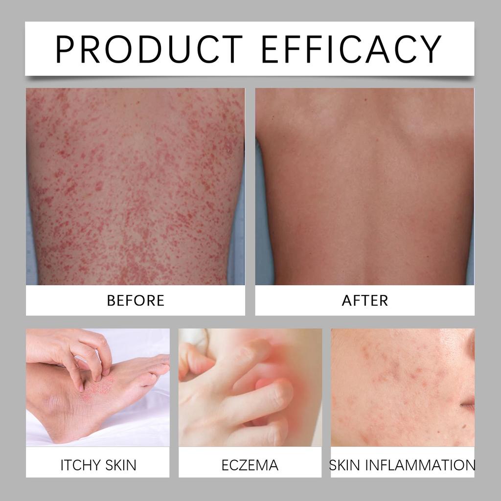Многофункциональный крем для ухода снимает экзему и воспаление кожи, глубоко увлажняет кожу и укрепляет ее барьер.