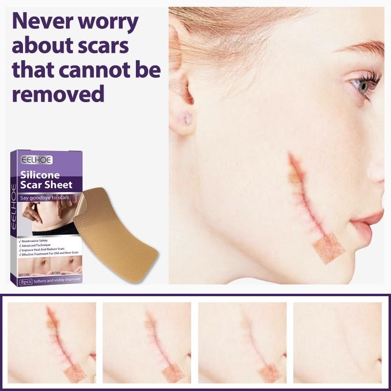 Eelhoe Silicone Scar Patches For Reducing Pregnancy And C-section Scars Effectively