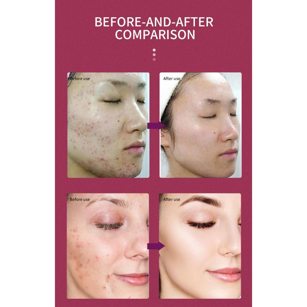 Fruit Acid Essence Fine Pore Cleansing Skin Brightening Skin Skin Softening Corneous Skin Care Product Liquid