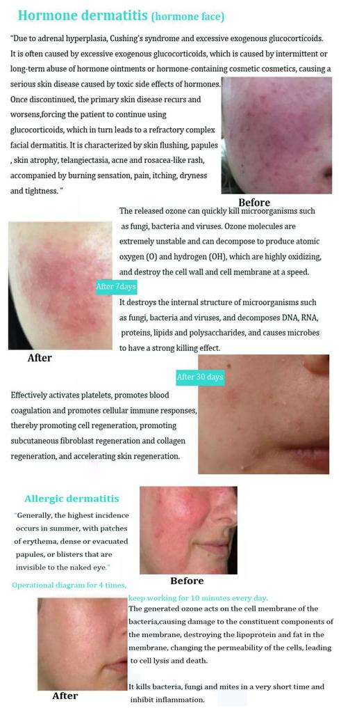 Professional Ozone Plasma Pen Machine for Alleviating Skin Aging Skin Rejuvenation Whitening Acne Treatment Plasma Pen