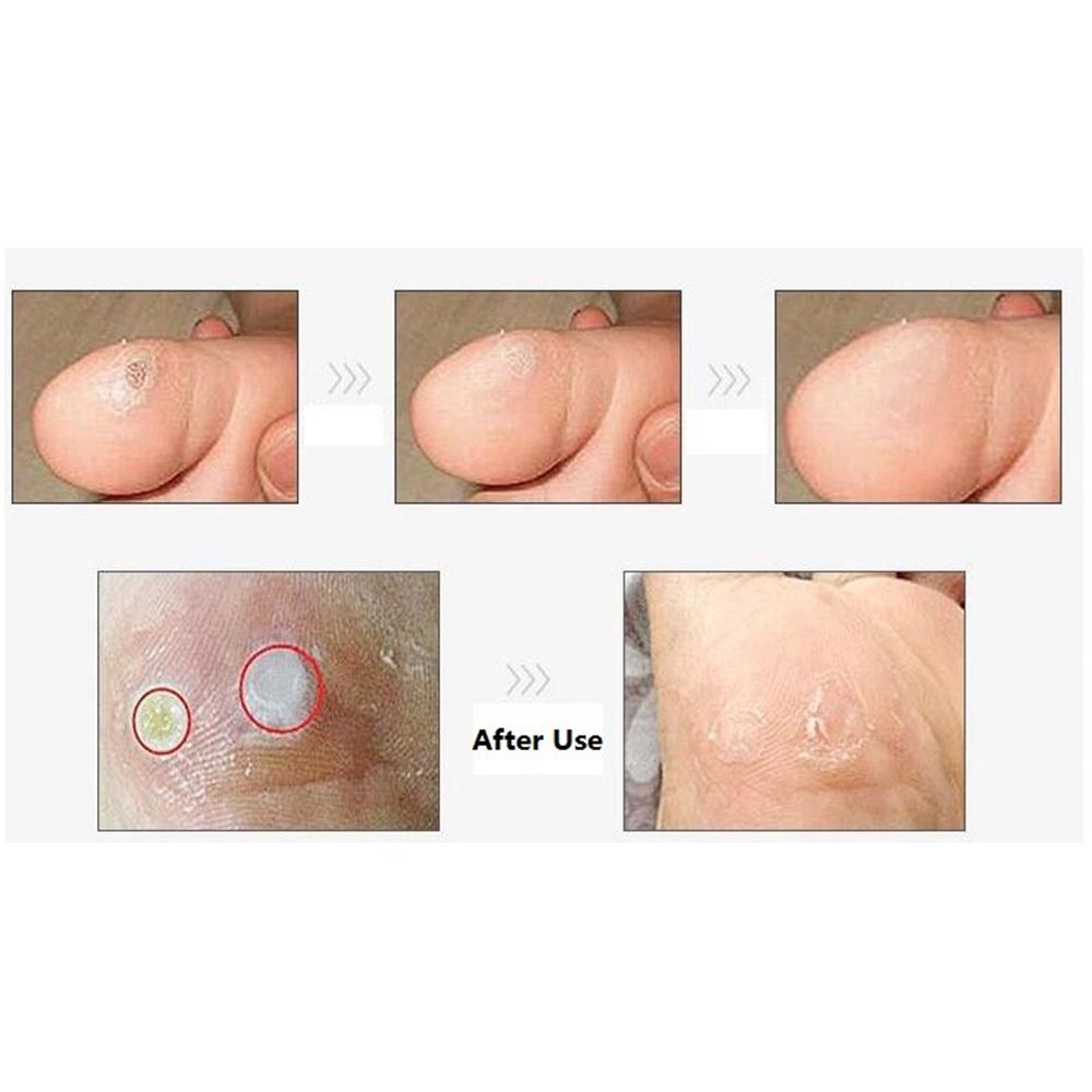 KONGDY 12 штук = 2 пакета пластырей для ухода за ногами, снимающих трение и давление на пальцы ног