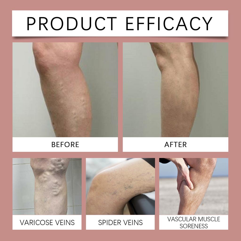 Успокаивающий крем для варикозного расширения вен. Массаж для лечения варикозного расширения вен. Уход за синими венами и красными кровяными нитями. Массаж для лечения варикозного расширения вен.