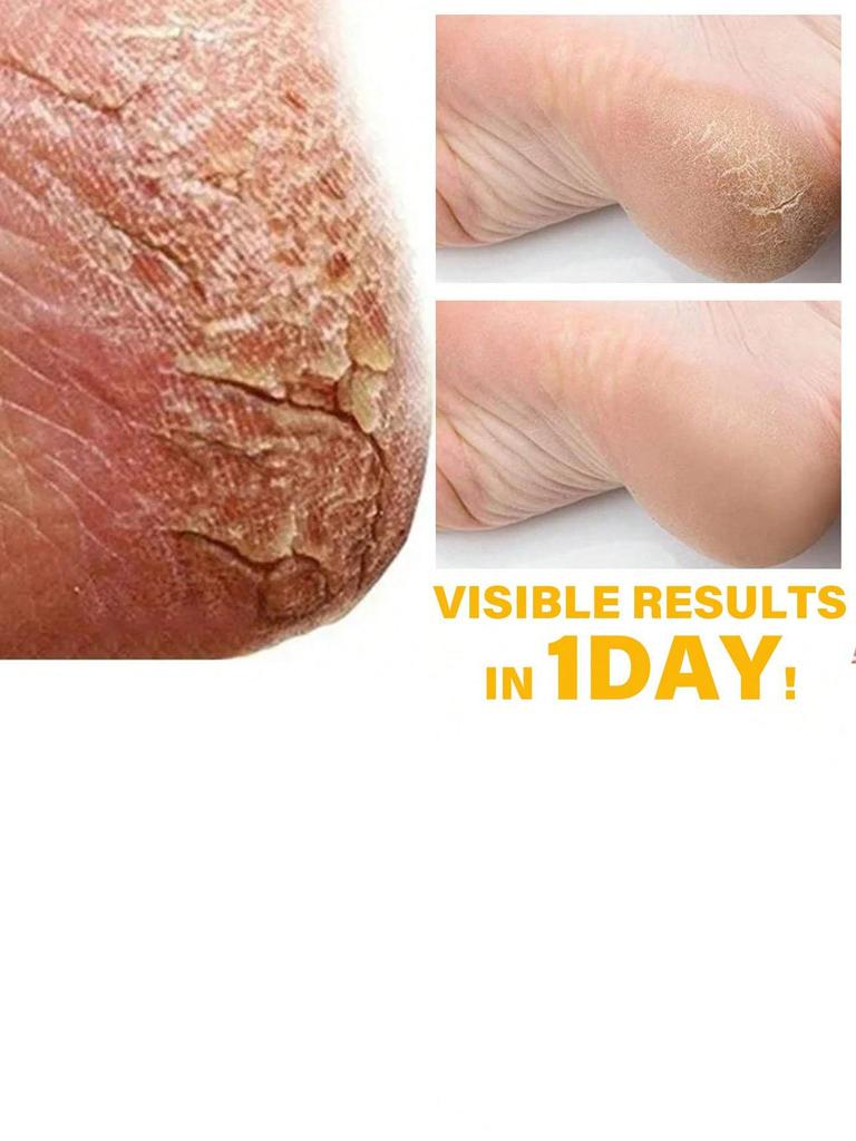 Foot Moisturizing Cream Is Rich In Plants and Can Be Used Flexibly for Dry, Cracked, and Rough Skin. Foot Moisturizing Cream