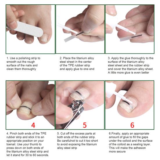 Набор для коррекции вросшего ногтя из титанового сплава для исправления искривленного ногтя Инструмент для лечения вросшего ногтя Выпрямитель для ногтей на пальцах ног