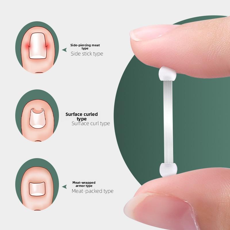Orthopedic Nail Groove Curl Nail Lala Orthopedic Patch Toenail Long Fleshy Inlaid Nail Traction Orthopedic Button Orthosis