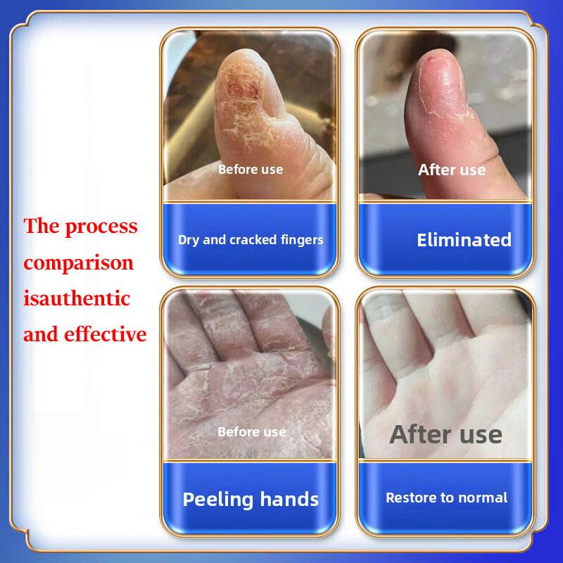 Полностью натуральный крем от дерматита - Успокаивает зудящую кожу, Мягкий для чувствительных типов, Облегчает экзему