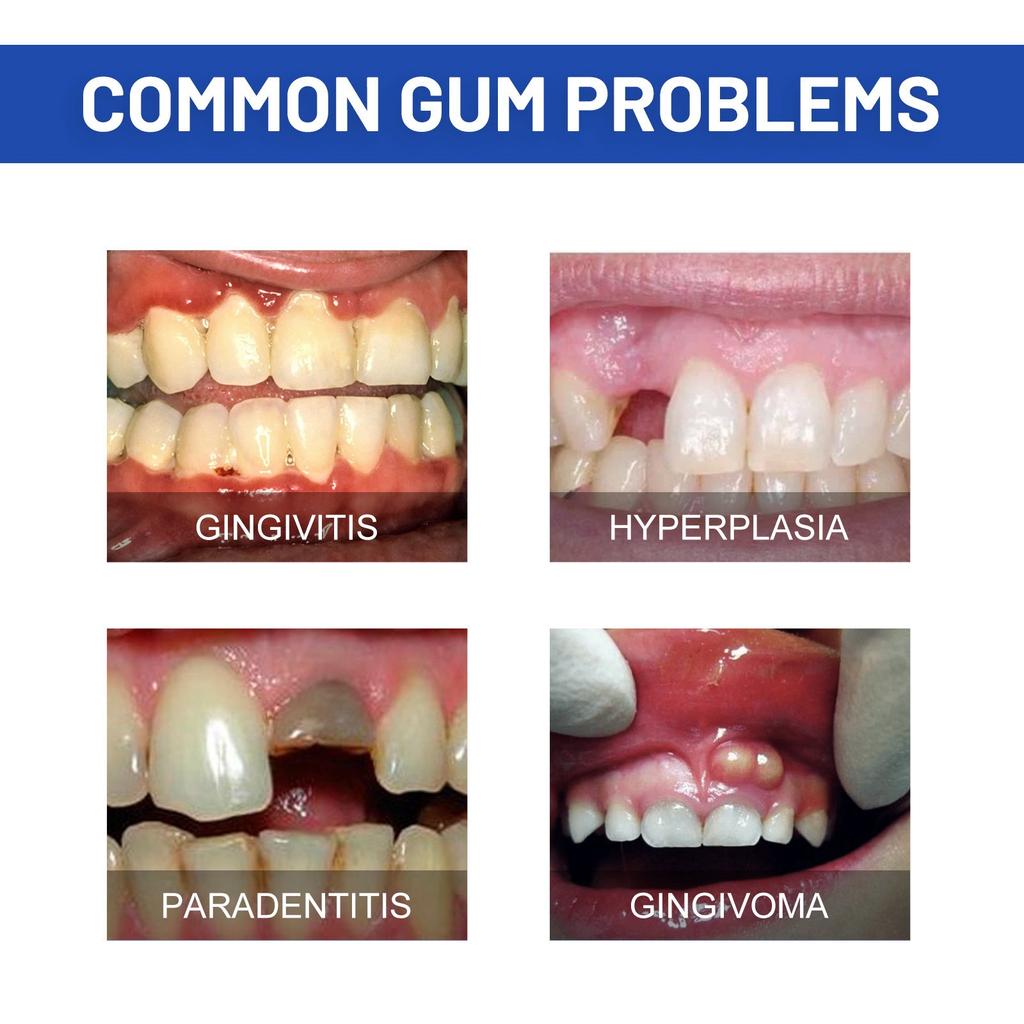 Gingival Gel Relieves Swelling And Pain Of Gums Cleans Tooth Stains Tooth Yellows Fresh Breath Care  4ml