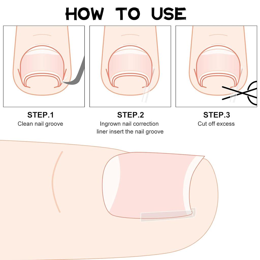Корректор вросшего ногтя Полоски Ноготь Коррекция Ногтя Корректор Зажим Для Коррекции Выпрямление Ногтя Восстанавливающий Пластырь Корректор Изогнутого Ногтя 2 Стили