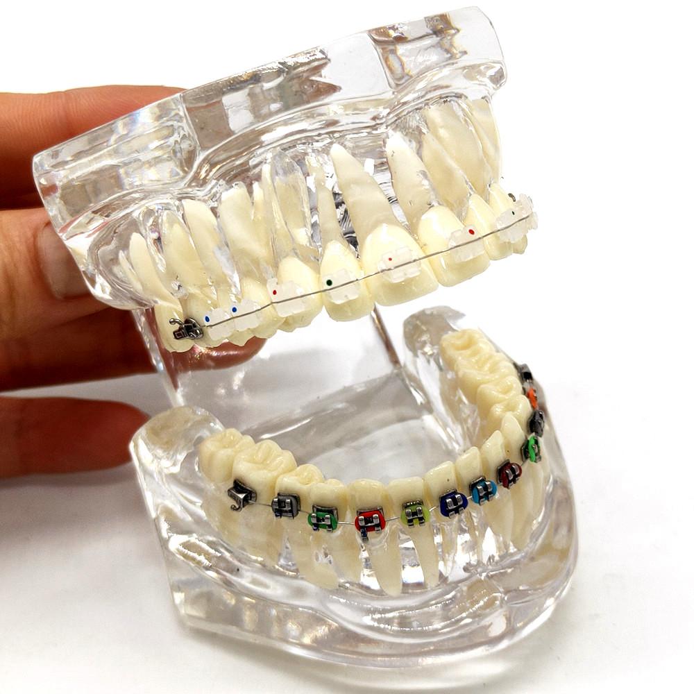 1 шт., стоматологическая ортодонтическая модель, связь с пациентом, 2 вида брекетов с дугами, лигатуры, керамический брекет, металлический краевой брекет