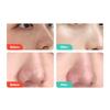 Salicylic Shrink Pore Cream Improve Acnes Blackheads Whitening Anti-Aging