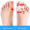 2 пары разделителей для пальцев ног, распорки для пальцев ног, корректор вальгусной деформации, силиконовые ортезы, облегчение боли при вальгусной деформации
