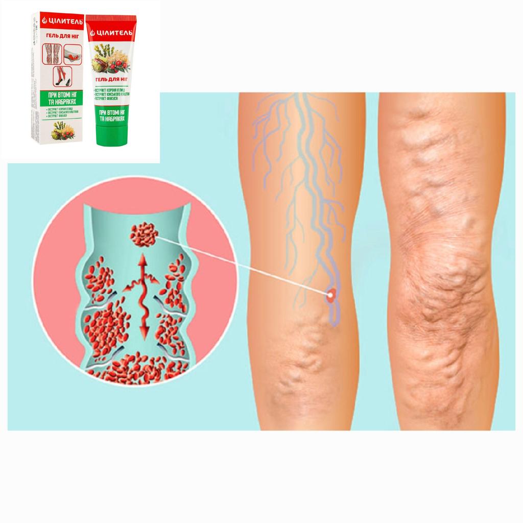 Foot gel for leg fatigue, swelling "HEALER", 70 g varicose veins - a universal assistant to the legs
