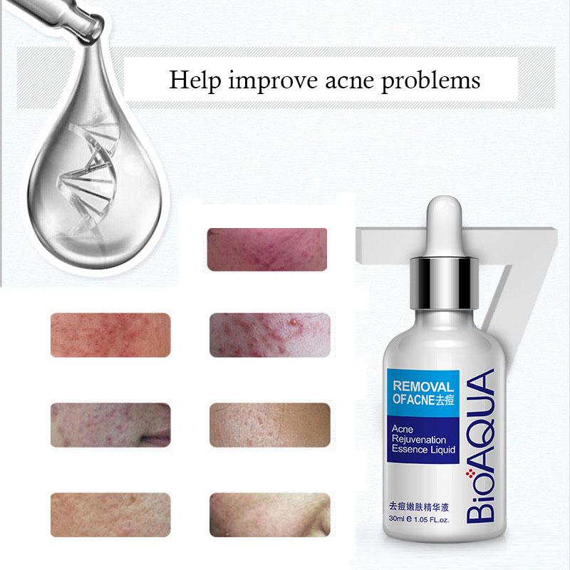 30 мл отбеливающая и анти-акне эссенция для лица, увлажняющая и жирная сыворотка для лица