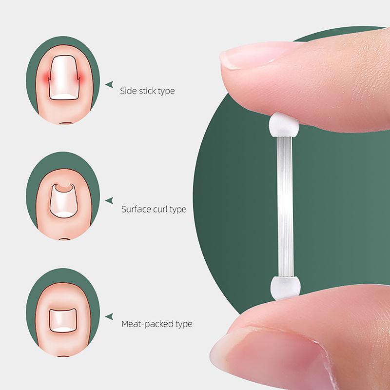 Лечение вросшего ногтя на пальце ноги, эластичная наклейка, выпрямляющий зажим