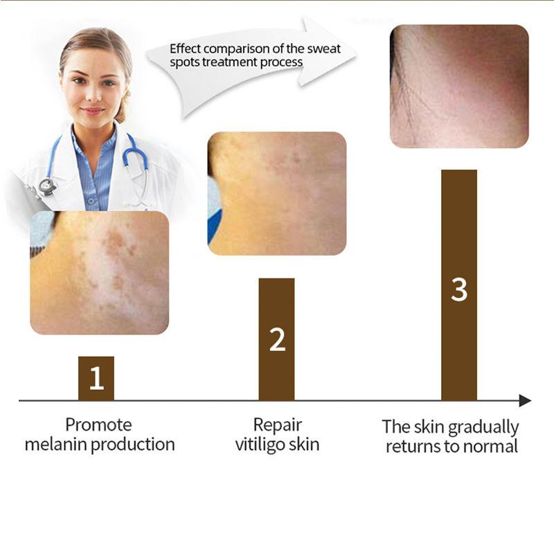 Отбеливающий крем для кожи Fade Темные пятна Белые пятна Монобензоновый отбеливающий крем для черной кожи