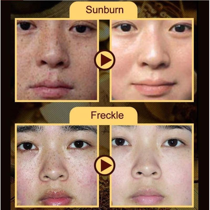 100% ORIGINAL Freckle Cream Anti-dark Spots and Brightening Skin Whitening Cream