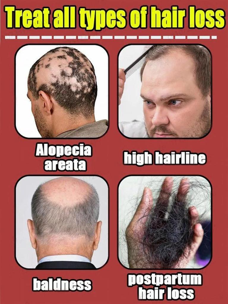 Натуральное эфирное масло для быстрого роста волос, средство против выпадения волос, эссенция для роста волос, лечение алопеции для женщин