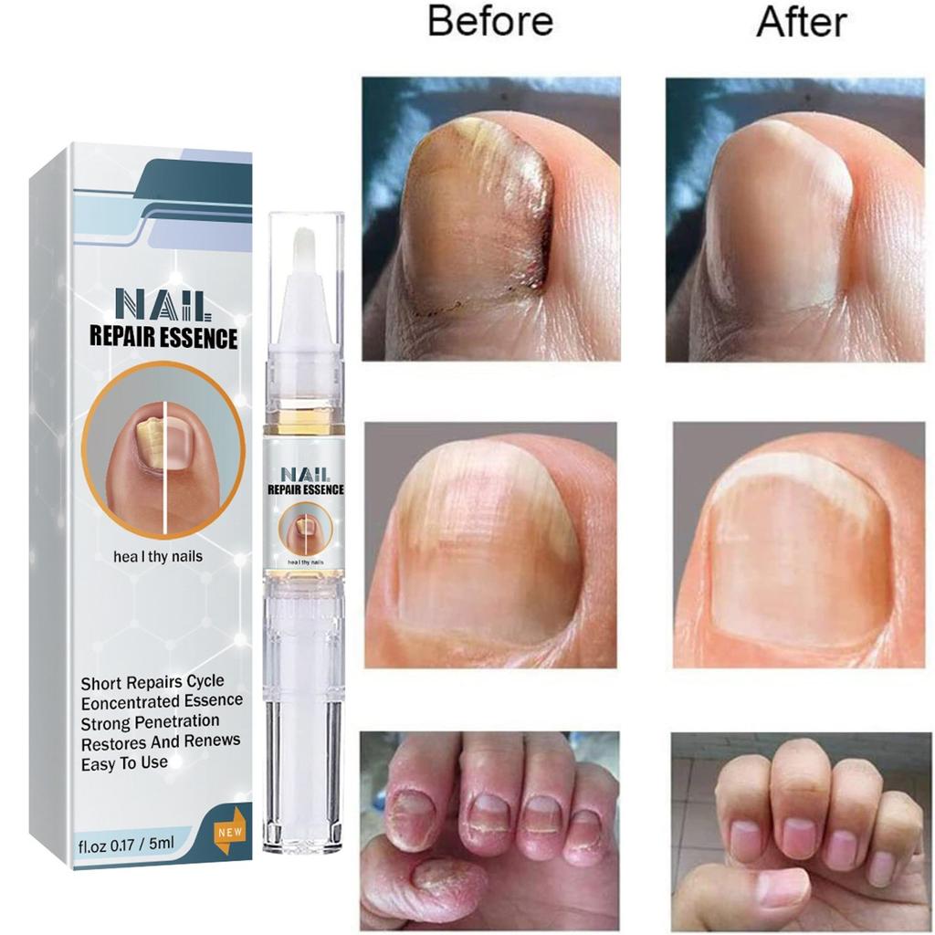 Exstroyeza Pen FUNGAL NAIL PEN Масло для ногтей 5 мл