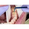 Waldent Silane Primer Syringe