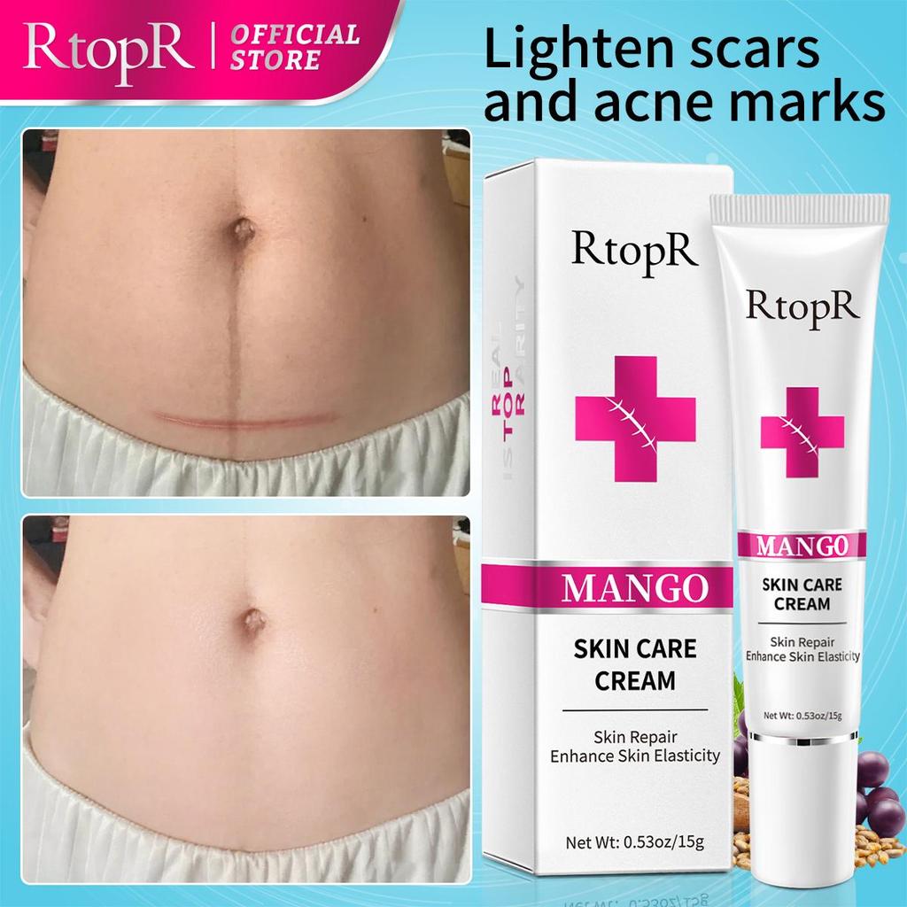 RtopR Acne Removal Cream - Spot Removal & Skin Repair 15g