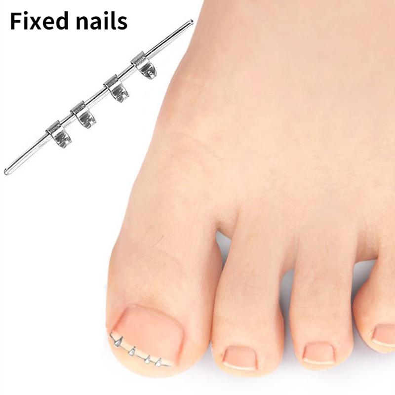 1 шт. Устройство для коррекции вросшего ногтя – Невидимый эластичный выпрямляющий зажим для выравнивания ногтя и ухода за педикюром