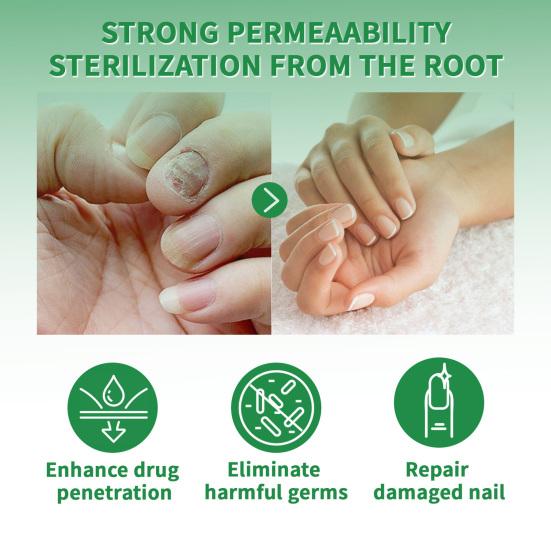 30ml Nail Growth Serum Ginger Nail Treatment Nail Growth Repair Essential Oils