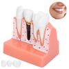 Модель зубов Анализ зубного имплантата Модель короночного моста Демонстрационная модель зуба
