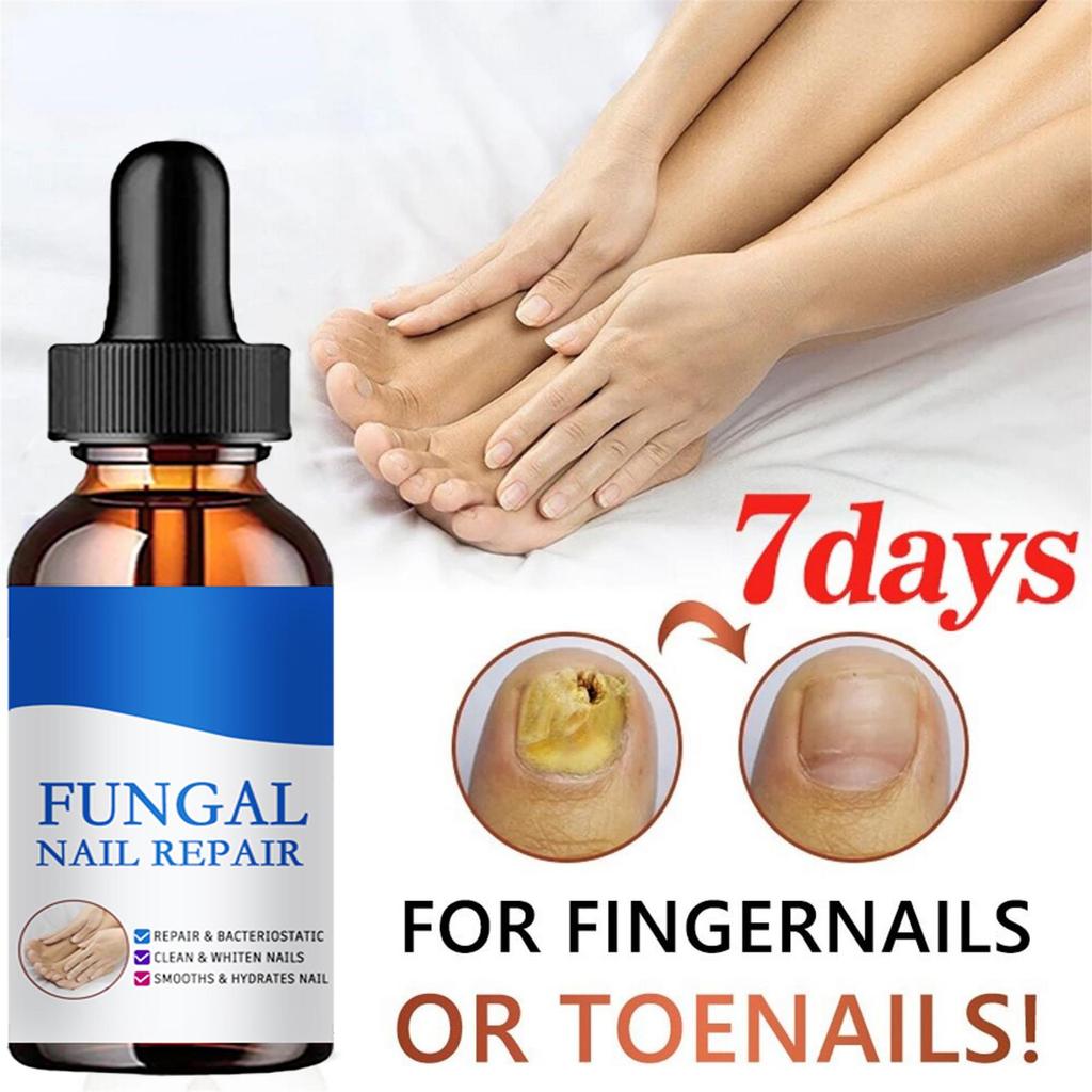 Repair Nail Fungus Treatments Essence Foot Care Serum Toe Nails Fungal Removal Gel Anti-Infection