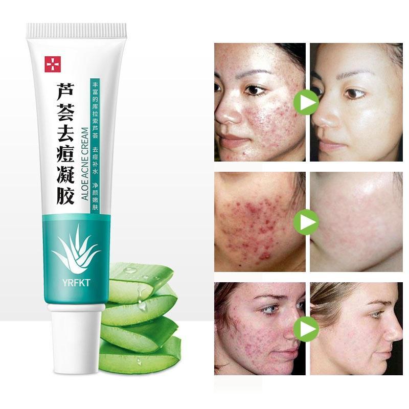 Крем против прыщей с экстрактом алоэ вера, крем для сна, сужающий поры