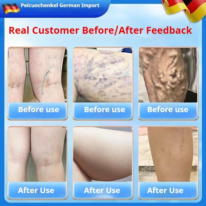 Крем от варикоза с растительным экстрактом