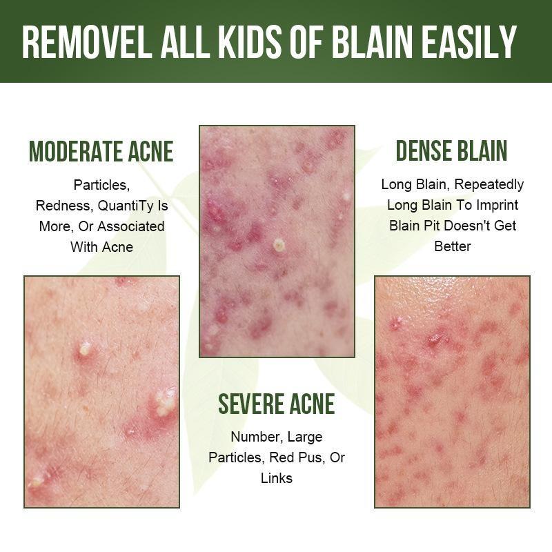 Крем для удаления прыщей, отбеливающий, исчезающих пятен, крем для удаления шрамов от прыщей, восстановление шрамов от прыщей, сужение пор, уход за кожей