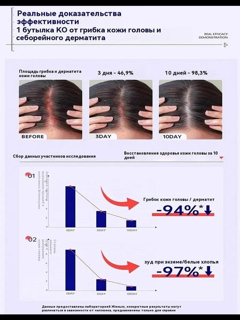Ringworm Capitis and Scalp Special Spray Fungal Infection Dandruff Itching