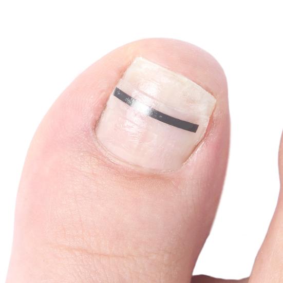 Набор для коррекции вросшего ногтя из титанового сплава для исправления искривленного ногтя Инструмент для лечения вросшего ногтя Выпрямитель для ногтей на пальцах ног