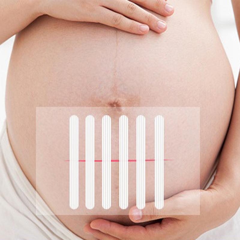 Полоски для закрытия ран после родов, пластырь для косметической хирургии, безшовный пластырь, хирургическая лента без швов
