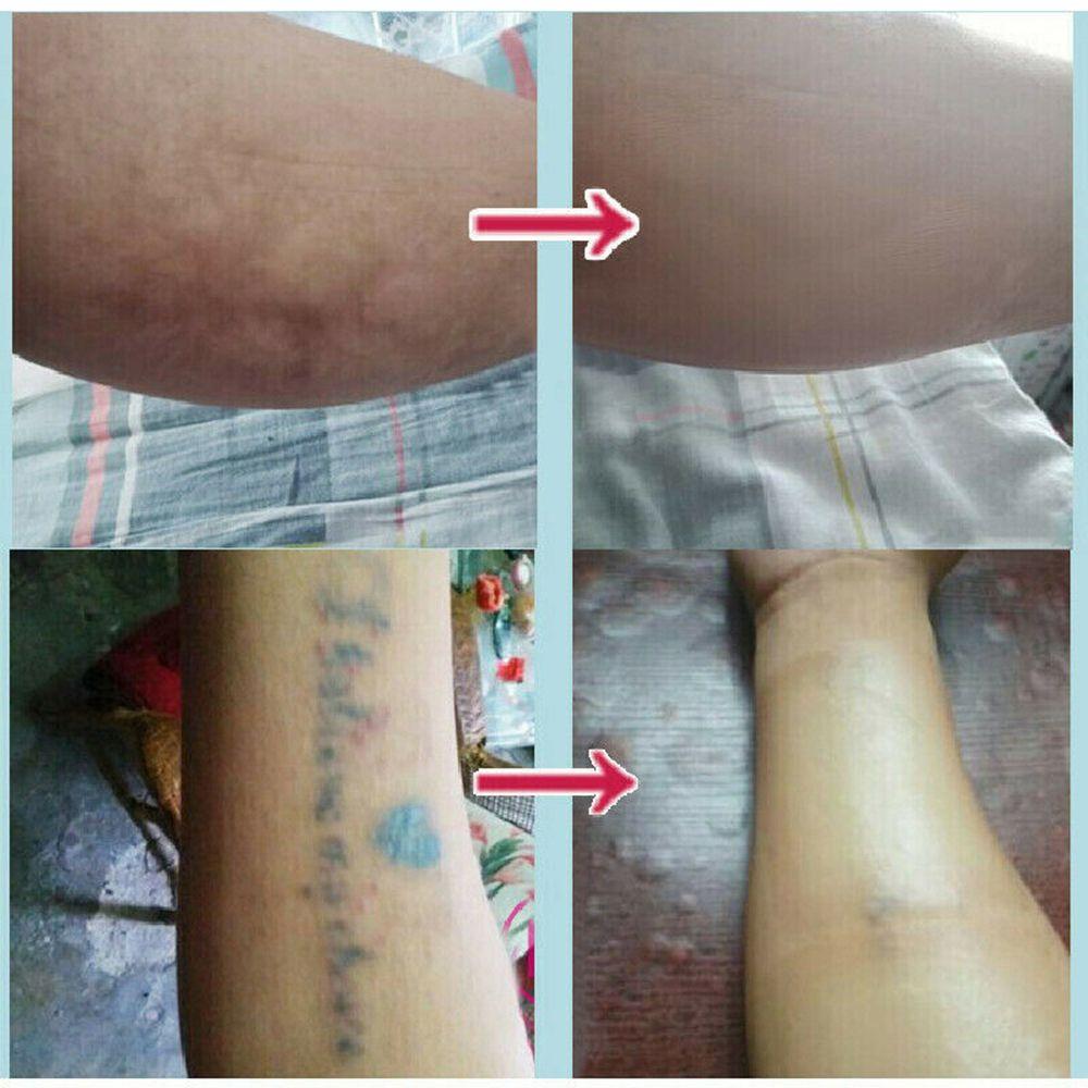 Водонепроницаемая лента для родинок, шрам, акне, консилер, тату, наклейка, приятная для кожи