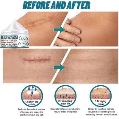 Крем для отбеливания и удаления рубцов, для удаления рубцов и угрей, противовоспалительный и восстанавливающий поврежденную кожу, ровный тон кожи, увлажняющий крем